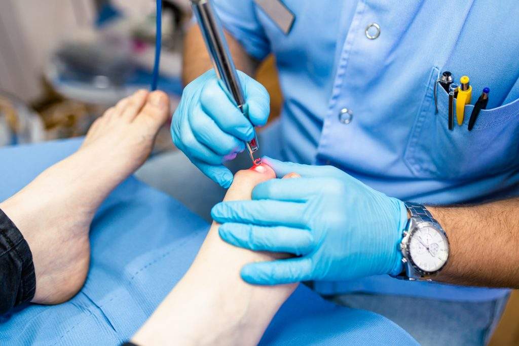 Toenail fungus treatment with foot laser at laser nail therapy clinic.