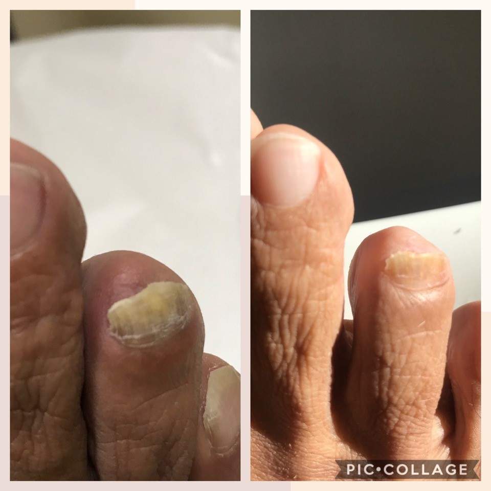 Toe Nail Fungus Treatment Colorado Springs, CO Toe Nail Laser Treatment